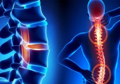 Spinal Disorder