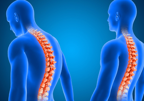 Lumbar spondylosis