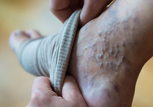 Varicose Veins